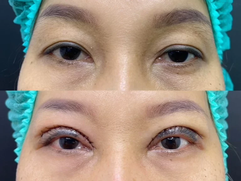 การศัลยกรรมทำตากรีดสั้นและกรีดยาว: การแก้ไขปัญหารอบดวงตา