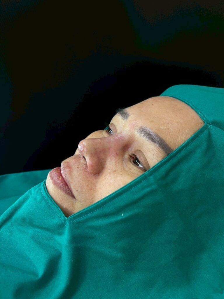 เสริมจมูกแบบโอเพ่น (Open Rhinoplasty) คืออะไร? ข้อดี ข้อควรรู้ และเหมาะกับใคร