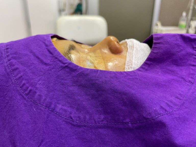 เสริมจมูกพักฟื้นกี่วัน (สรุปสั้นสำหรับคนรีบ)