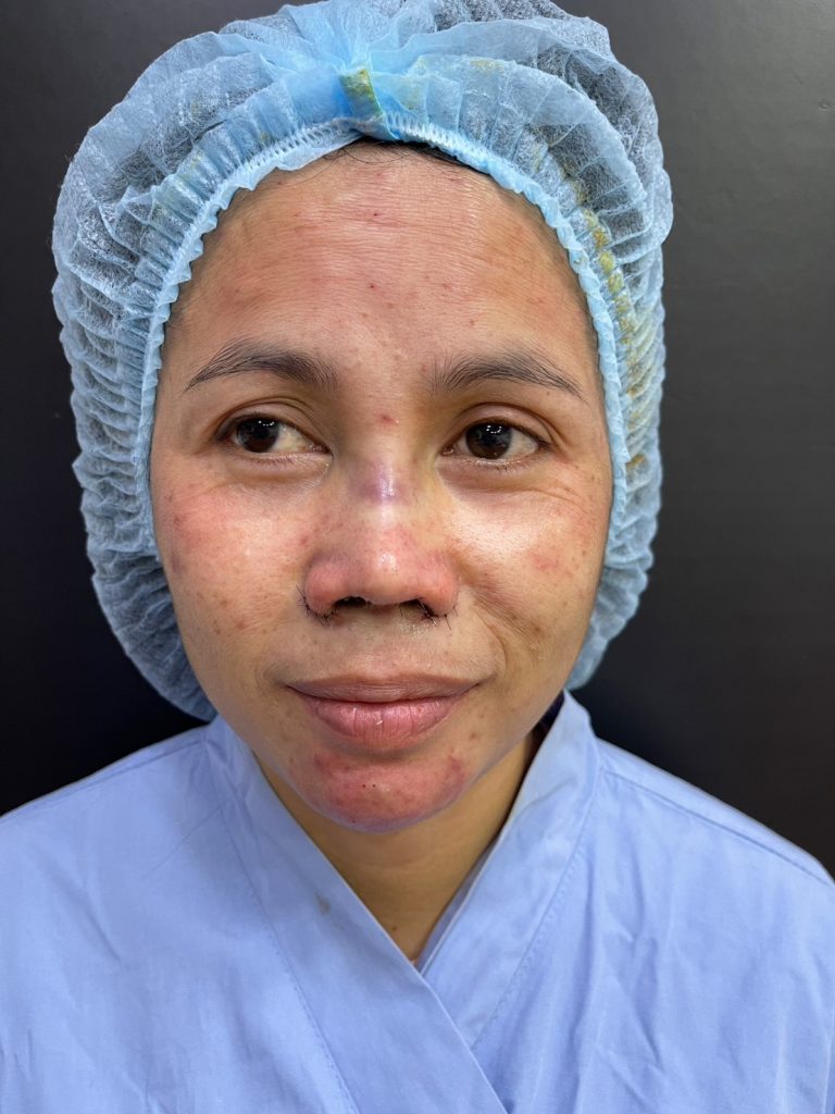 เสริมจมูกที่ไหนดี ทำไมต้องเลือกให้ดีตั้งแต่ครั้งแรก