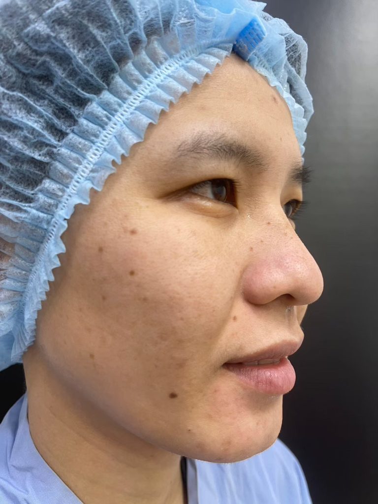 เสริมจมูกซิลิโคนพรีเมี่ยม ทางเลือกยอดนิยมเพื่อจมูกสวยละมุนอย่างเป็นธรรมชาติ